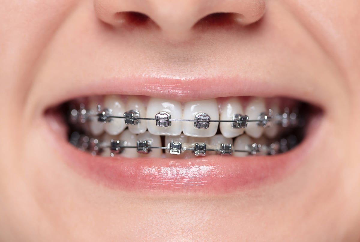 Woman with braces on her teeth is smiling. Metal bracket system on the teeth of a young woman