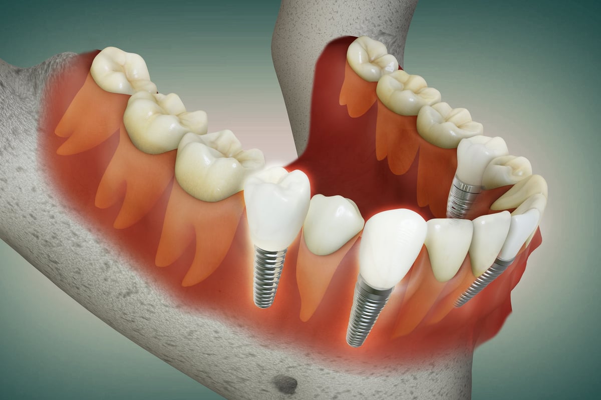Imagen de renderizado 3D de múltiples implantes dentales alineados con dientes y encías saludables