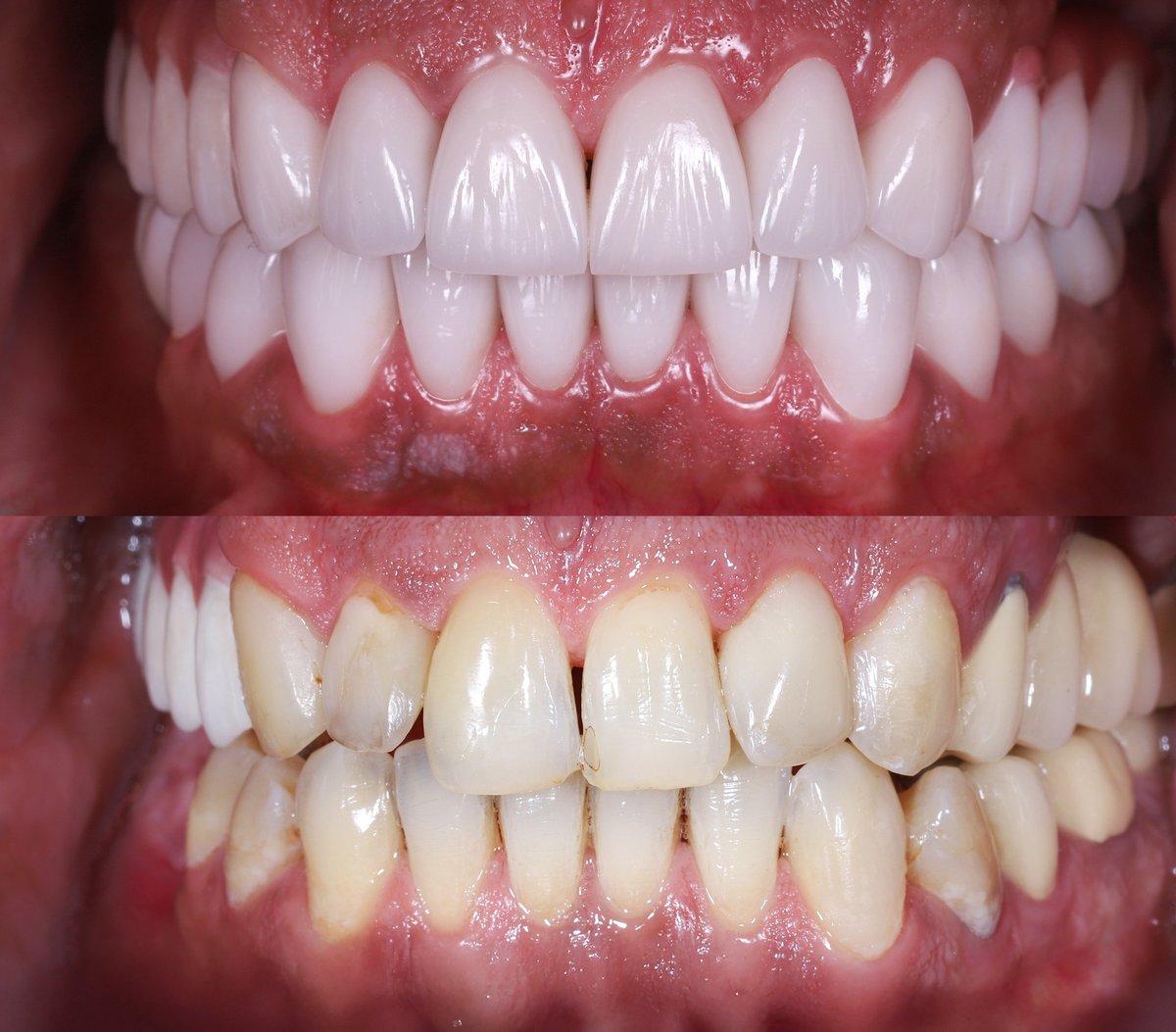 Carillas cerámicas emax, antes y después de un tratamiento de diseño de sonrisa