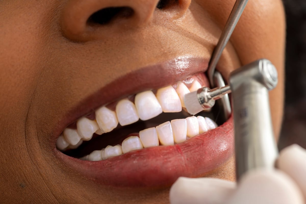 Vista cercana de un dentista puliendo los dientes de un paciente, mostrando precisión y cuidado en una clínica dental