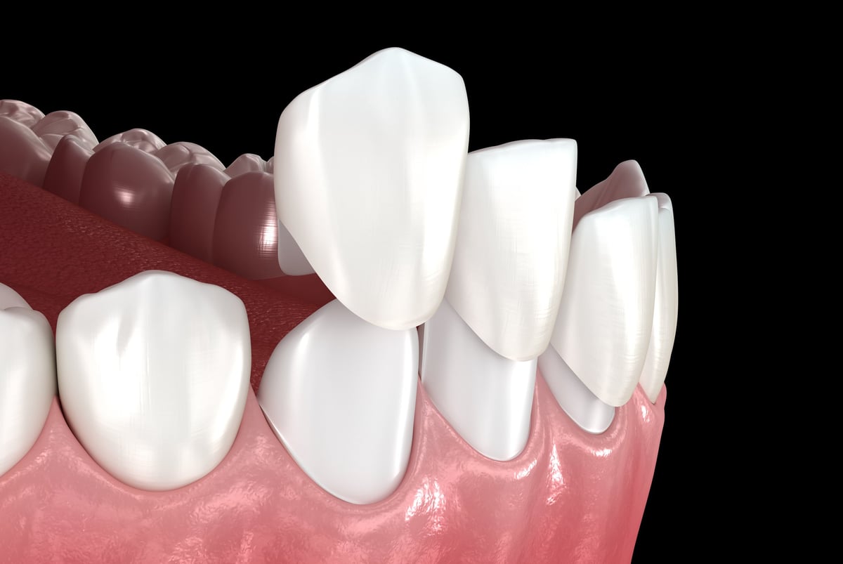 Colocación de carillas dentales sobre dientes frontales, ilustración 3D
