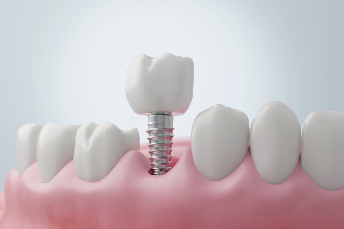 Instalación de implante dental de titanio para reemplazo de molar, mostrando el tornillo colocado en el hueso maxilar