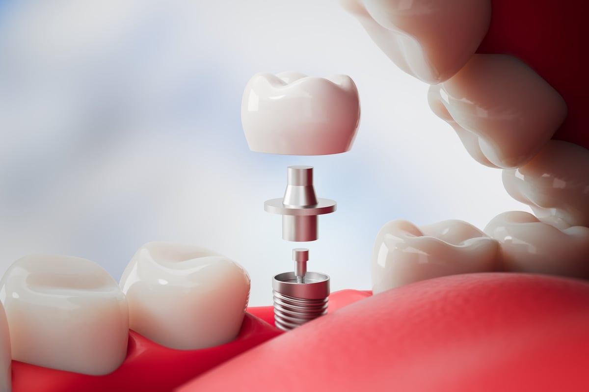Partes de un implante dental: corona, pilar y tornillo dentro de una boca abierta, renderizado 3D realista