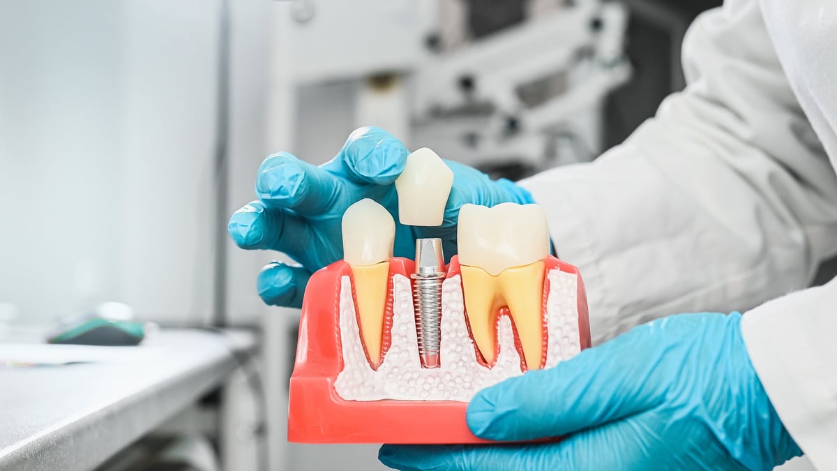 Concepto de odontología e implantología dental profesional