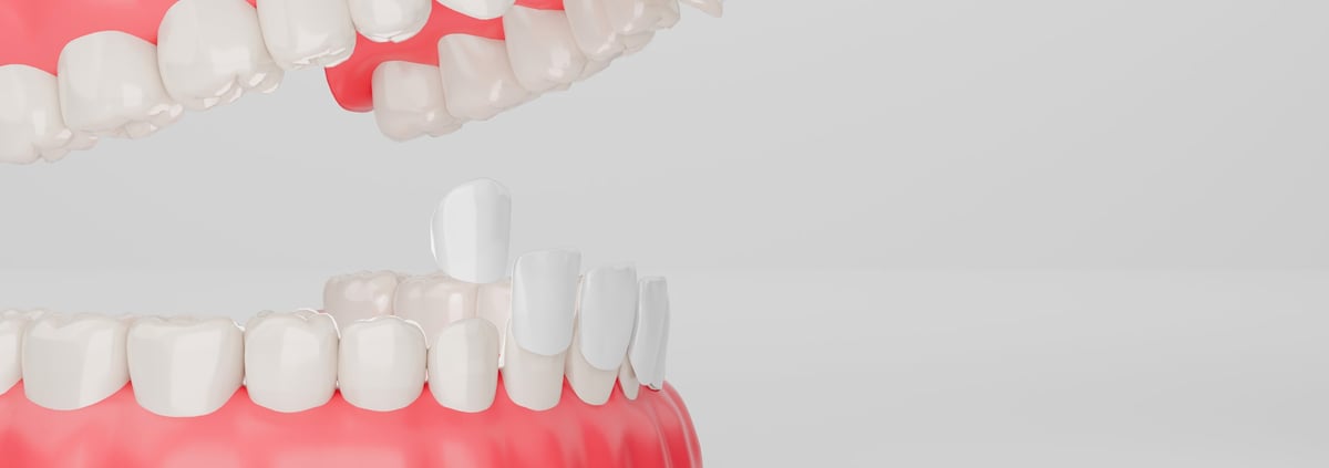 Ilustración detallada 3D de carillas dentales siendo aplicadas en dientes frontales inferiores