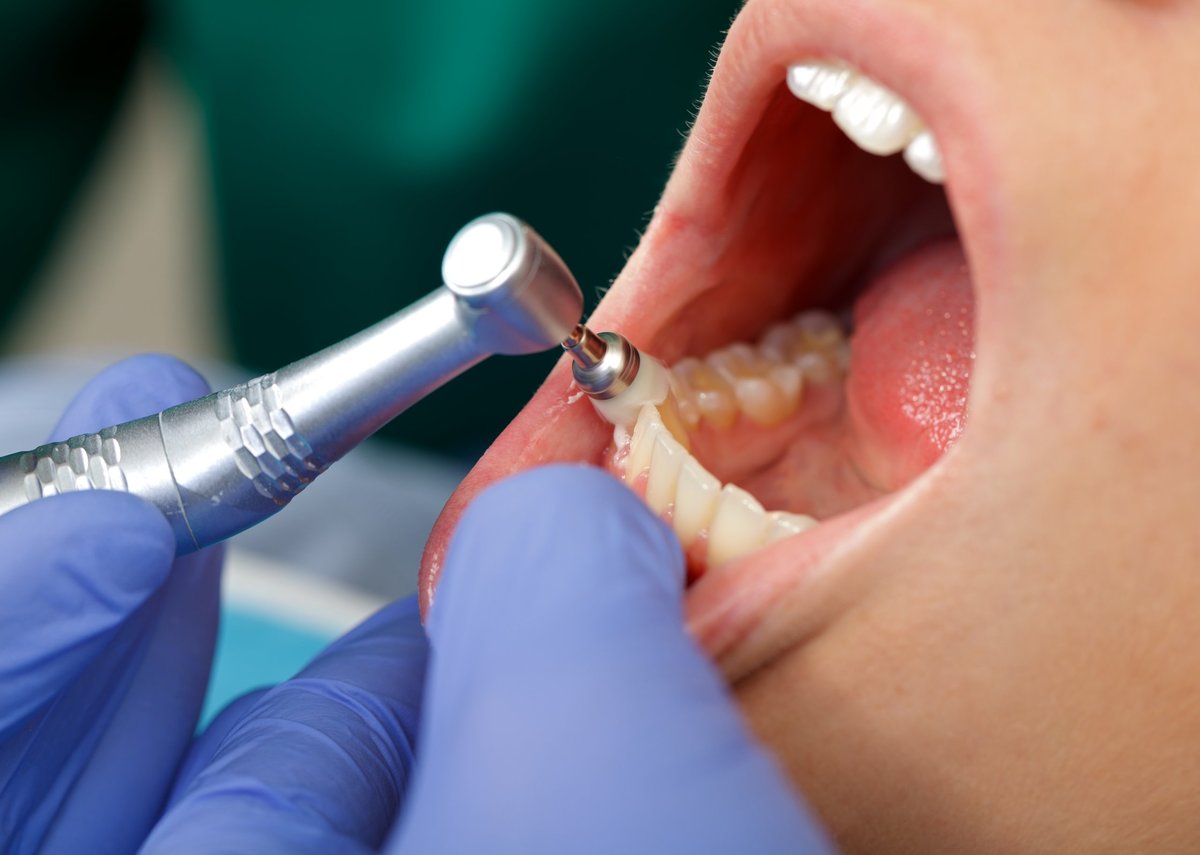 Primer plano de un cepillado dental profesional en una clínica