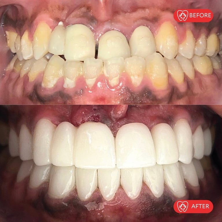 Before and after dental treatment showing yellowed, damaged upper teeth transformed to bright, even white teeth