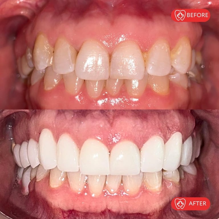 Before and after dental treatment comparison showing discolored teeth transformed to bright white veneers