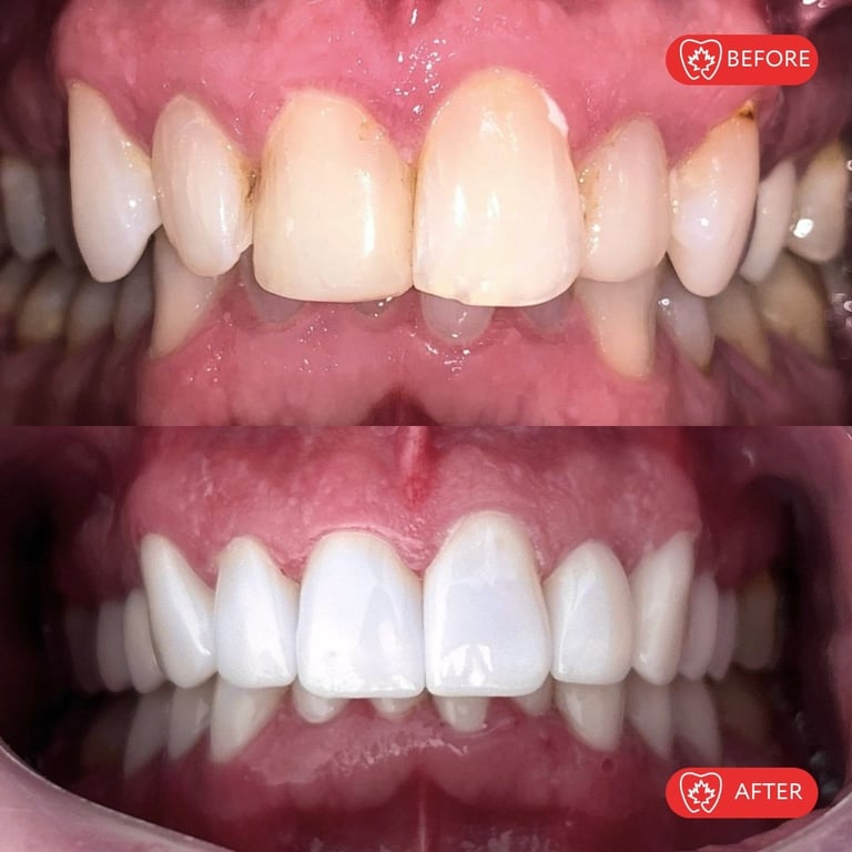 Before and after dental treatment showing teeth whitening and cosmetic improvements to front teeth
