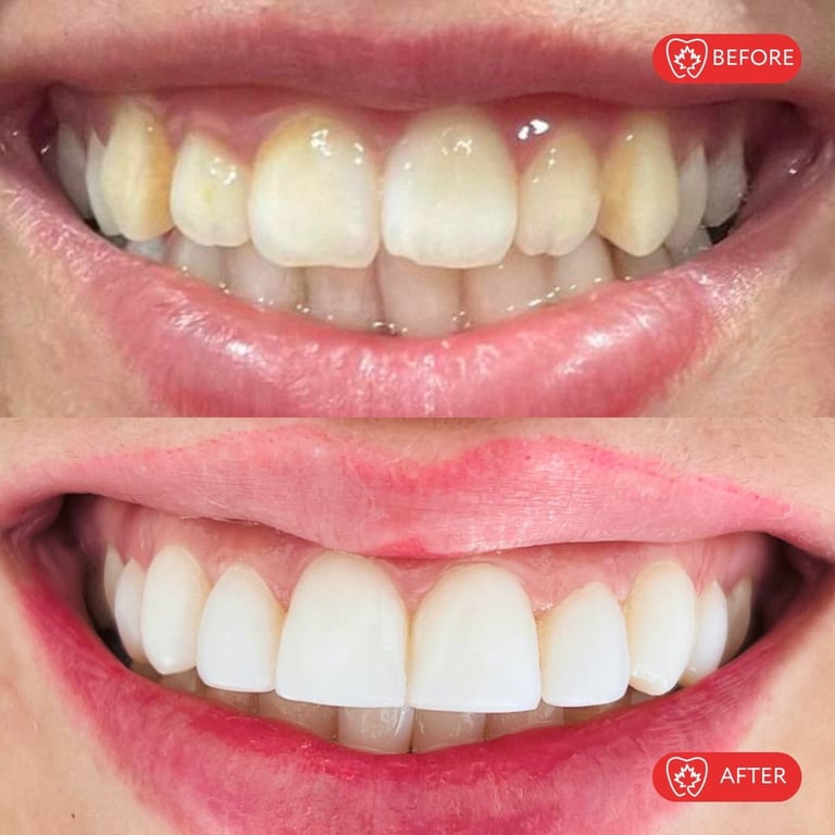 Before and after comparison of teeth whitening treatment showing improved tooth brightness and whiteness